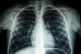 Lung scan Pic: Umanoide / Creative Commons