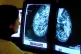 A consultant analysing a mammogram