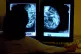 A consultant studying a mammogram showing a woman's breast i
