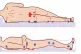 Pressure ulcer points. Red: In supine position. Blue: in sid